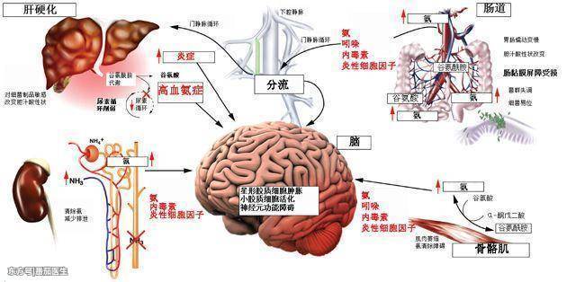 肝性脑病分期5期最新研究概述